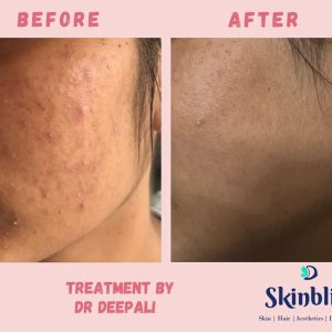 acne-&-acne-scars-removal-treatment-in-jubilee-hills