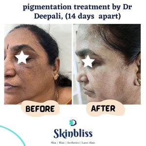 skin-pigmentation-treatment-by-dr-deepali-at-skinbliss-clinic-in-hyderabad
