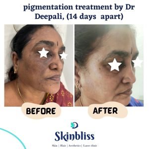 pigmentation-treatment-result-by-dr-depali