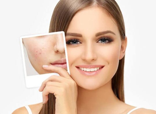 acne-&-acne-scare-removal-treatment-in-hyderabad
