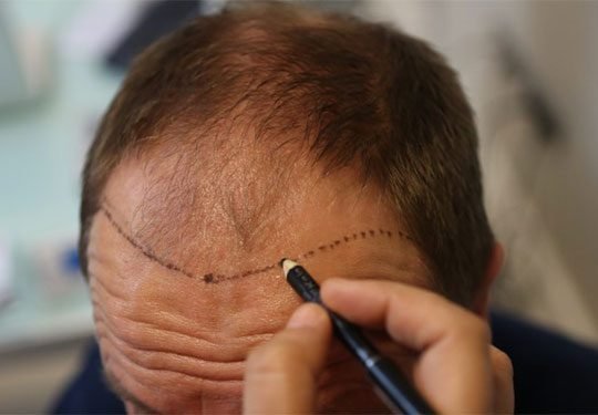 get-hair-transplant-treatment-at-skinbliss-clinic-in-hyderabad