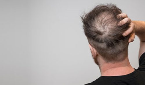 male-hair-loss
