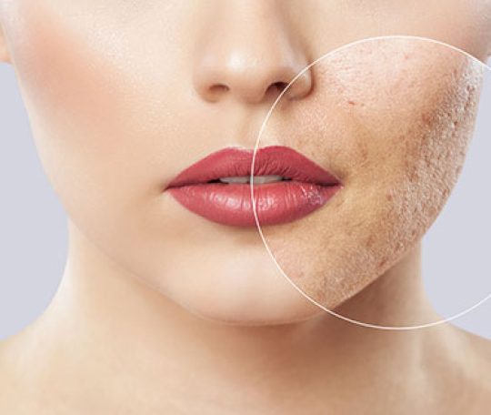open pores treatment by skinbliss clinic in Hyderabad