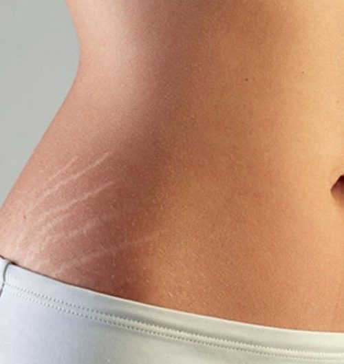 stretch mark reduction in Hyderabad at skinbliss clinic