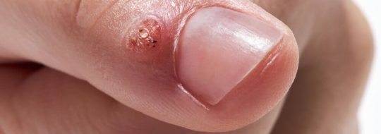 corn-wart-removal-at-skinbliss-Clinic-in-hyderabad