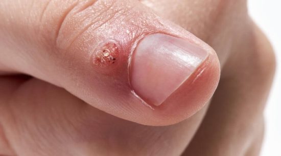 corn-wart-removal-at-skinbliss-Clinic-in-hyderabad